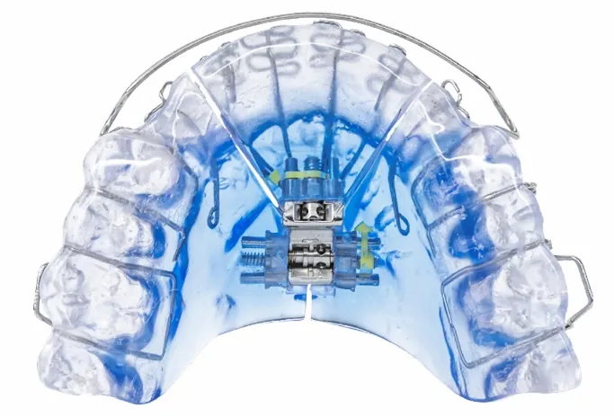 Vivos mouth guard for sleep apnea